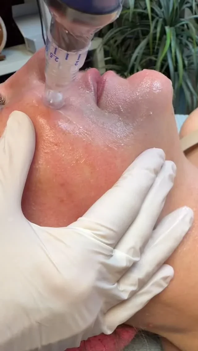 SkinPen — always a good way to jump-start collagen.